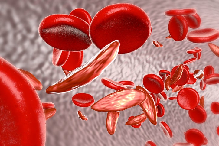 4 Facts About Sickle Cell Disease